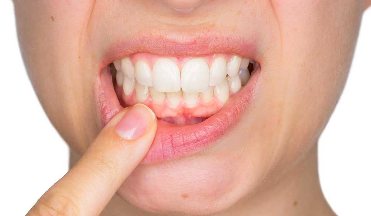 how-to-properly-treat-gum-diseases.jpg