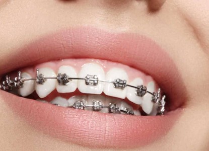 Everything you Need To Know About Braces