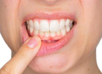 How to Properly Treat Gum Diseases